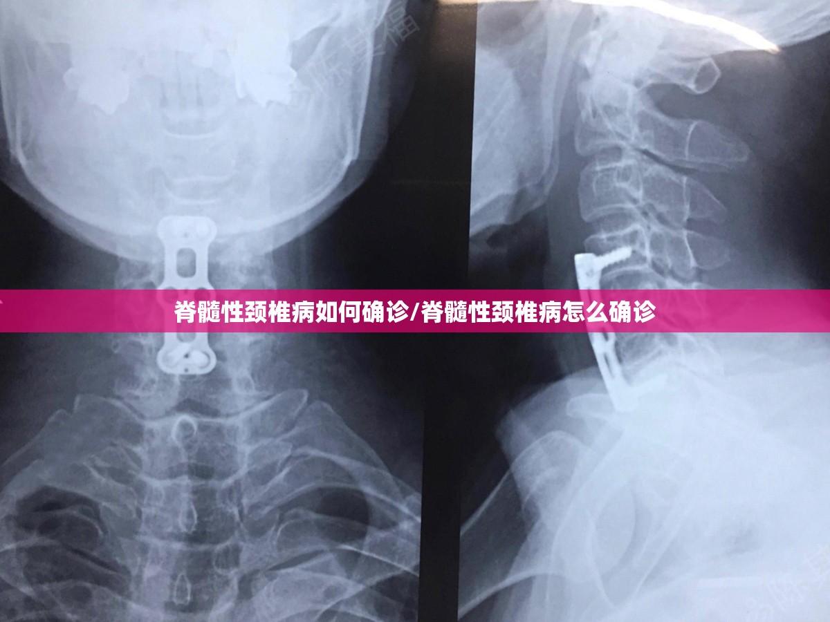 脊髓性颈椎病如何确诊/脊髓性颈椎病怎么确诊
