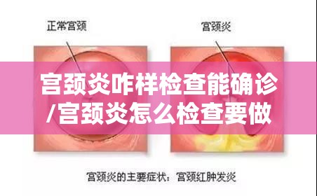 宫颈炎咋样检查能确诊/宫颈炎怎么检查要做什么